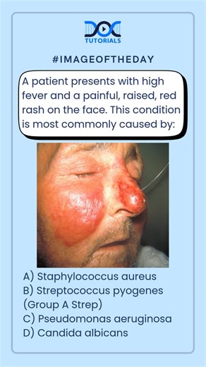 DocTutorials - NEET PG on Instagram: "#imageoftheday 👉 A patient presents with high fever and a painful, raised, red rash on the face. This condition is most commonly caused by: A) Staphylococcus aureus B) Streptococcus pyogenes (Group A Strep) C) Pseudomonas aeruginosa D) Candida albicans 💬 Drop your Answer in Comments👇 #NEETPG #NEETPGMCQ #Erysipelas #StreptococcusPyogenes #GroupAStrep #Microbiology #Dermatology #FMGE #INISET #MedicalMCQs #PGMedicalPrep #DocTutorials #NEETPGPreparation #Clin