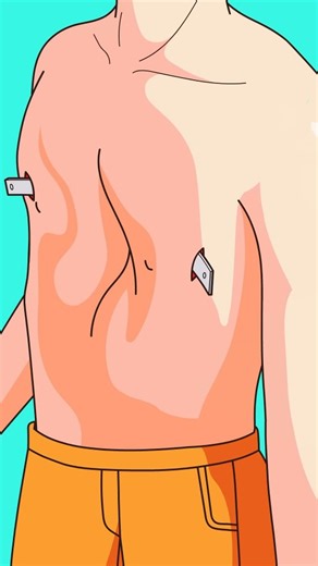 Craftee Films on Instagram: "Concave Chest: The Chest Cavity is Already Crowded, and Then They Add a Steel Plate?"