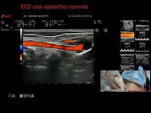 ECD vasi epiaortici normali