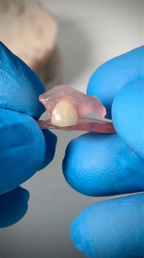 FiberFlex Unilateral that my lab just completed for Dr. Chris Davenport in Virginia