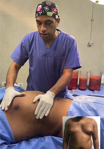 حل مشكلة التثدي عند الرجال بطرق فعالة