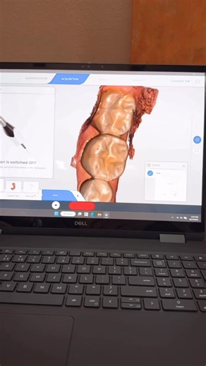Practicing with our Dentsply Sirona digital scanner!Alginate impressions are no longer a must. Pause the end of the reel for awesome info on why we added this incredible technology to our office! | Engelhardt & Nelson Family Dentistry