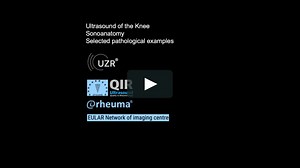 Musculoskeletal Ultrasound - Knee