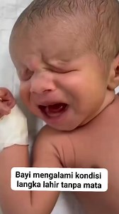 baby with rare condition born without eyes (Anophthalmia) #babybirth #prematurebaby #nicubaby #cutebaby #lievebaby #babylove #schattigebaby #nicuwarrior #vroeggeborenkind #babyborn #Lenouveaune | Yuli Ismalia