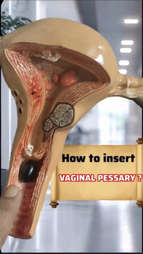 HOW to apply VAGINAL PESSARY II WHAT is VAGINAL PESSARY II #vaginalpessary #cansoftcl #fheal