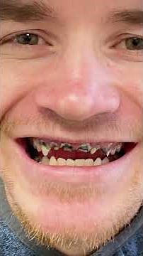 Before And After Nuvia's Permanent Teeth in 24-Hours! 🎉🦷