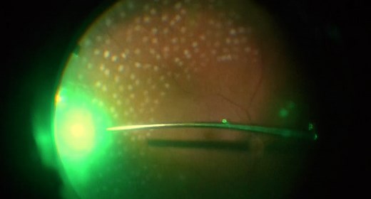 Endolaser Panretinal Photocoagulation (PRP) - Wills Eye Library