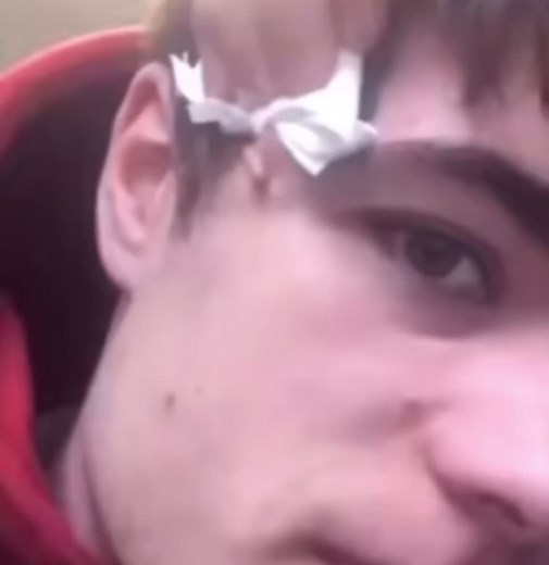 Head pop 2 #fypシ #spotpopper #pimplepop #fyp #trend #poppingzits