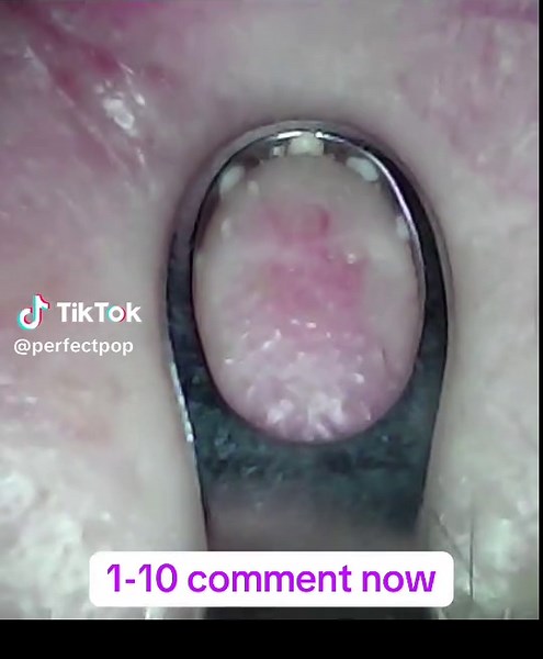 #multipop #blackhead #whiteheads #theperfectpop #asmr #undertheskin #satisfying #acne #pimplepopping #pimplepopper #nose #crease #creamy