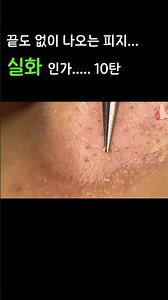 끝도 없이 나오는 피지... 실화 인가..... 10탄 #shorts