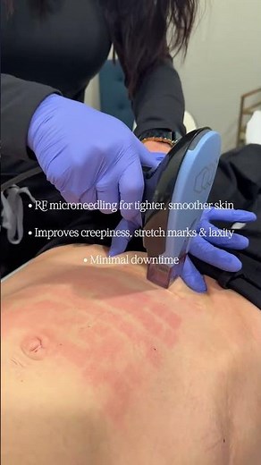 Morpheus8 Body Treatment