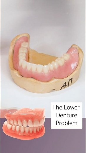 The Problem with Lower Dentures