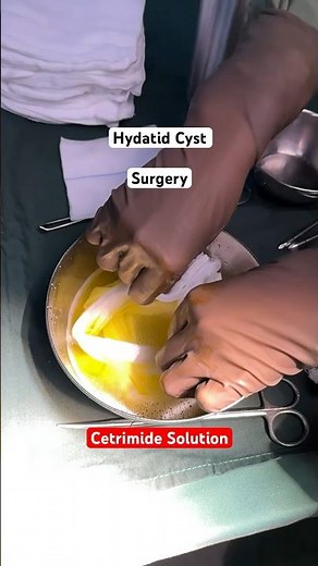 Hydatid Cyst I surgery I operation I cetrimide solution I india