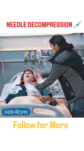 CoreScience-yt on Instagram: "Definition: Needle decompression is an emergency, life-saving procedure used to relieve tension pneumothorax by releasing trapped air from the pleural space.#viral #followforfollowback #science #medical #reels"