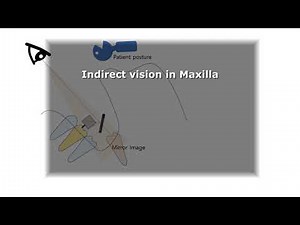 Dental Indirect Vision In Maxilla