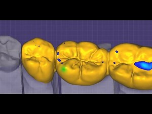 Exocad simple 3unit bridge design tutorial with BenA library