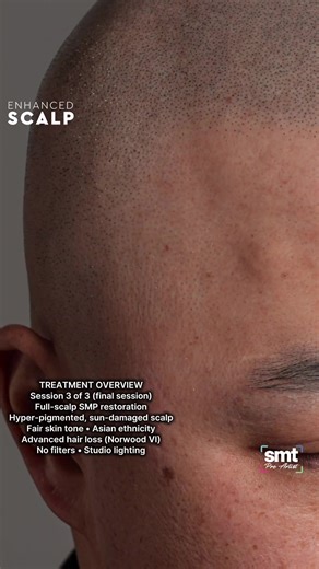 Post-Treatment Scalp Detail — (Final Session) TREATMENT OVERVIEW Full-scalp restoration Advanced hair loss (Norwood VI) Hyper-pigmented, sun-damaged scalp corrected Session 3 of 3 (final session) No filters • no editing • studio lighting #scalpmicropigmentation #smpresults #smpartist #hairrestoration #malepatternbaldness