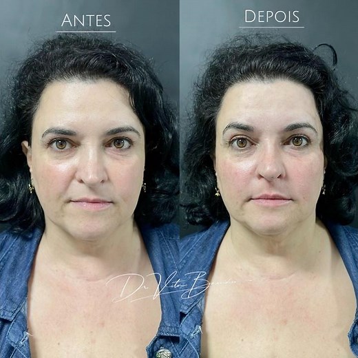 Harmonização suave com ácido hialurônico, botox e fios filler. Apenas 1 sessão! #harmonizacaofacial