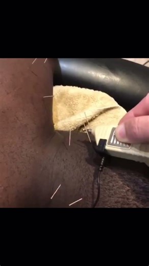Electro Acupuncture for larger patients #osteopathy #chiropractor #physiotherapist
