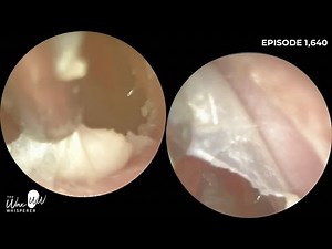 1,640 - Precision Dead Infected Ear Skin Peel