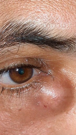 Blockage of the nasolacrimal duct, which causes excessive tearing (epiphora) or recurrent dacryocystitis (infection of the lacrimal sac). #dcr #ophthalmologist #optometrist #ocular #eyes #eyecare #disease #creater | Kathmandu Opticals & Eye Clinic