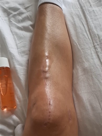 Can I Remove My Knee Screws Myself? MPFL Reconstruction & TTO Update
