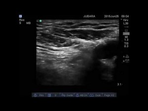 femoral branch of genitofemoral nerve block