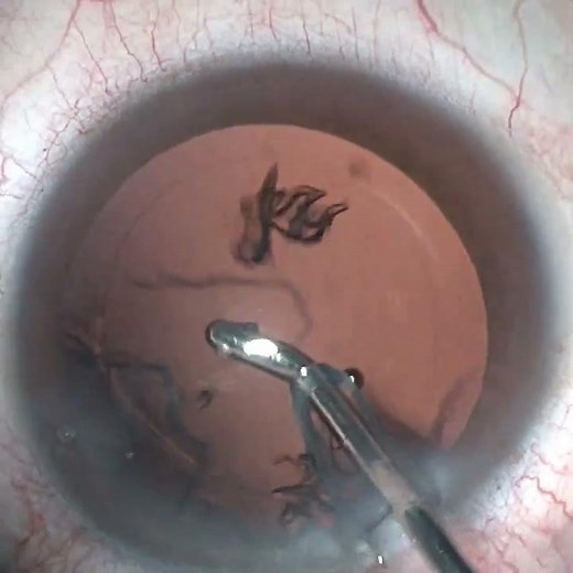 Novel Multifocal Intraocular Lens The Rayner Rayone Galaxy