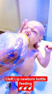 A cleft lip is a birth defect where a gap or split forms in the upper lip because the facial tissues did not join completely during pregnancy #baby #nicucare #NursingSkills #facts #babycare #nicubabynicubaby #babycaretips #viralvideochallenge This can range from a small notch to a more complete split that extends into the nose, and it may occur on one or both sides of the lip. It often requires surgery to repair and can affect feeding, speech, and hearing. Characteristics Appearance: A cleft lip