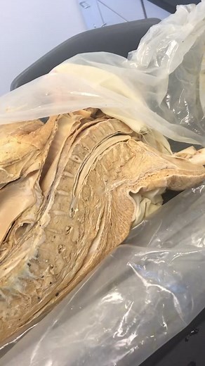 Exploring the Anatomy of Cauda Equina