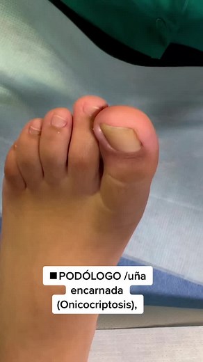 Extracción de espícula sin dolor en uña encarnada