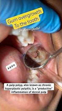 Pulp Polyps, Pulp overgrowth