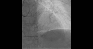 Coronary Artery Angiogram Detailed Imaging Stock Footage Video (100% Royalty-free) 3683123219 | Shutterstock