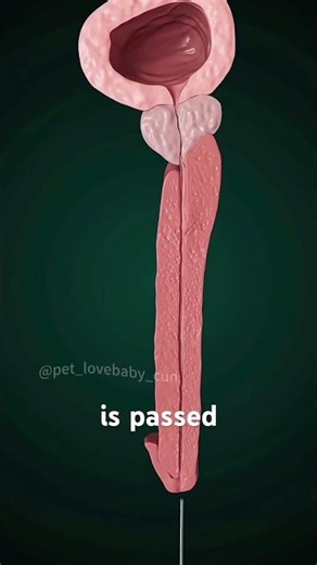 Enlarged Prostate Gland Surgery 3D Animation (Transurethral resection)#turp #transurethral