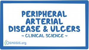 Peripheral arterial disease and ulcers: Video & Meaning | Osmosis