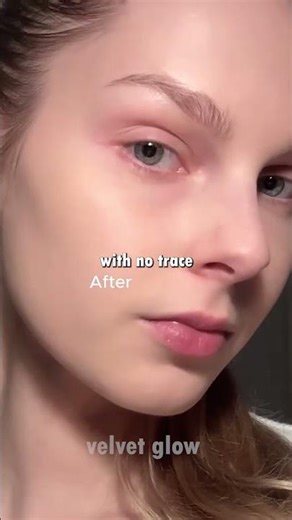 ✨ The Ordinary’s NEW Acne Treatment Clears Pimples in 1 Hour! ⏰
