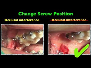 Resolving occlusal interference by ramus screw｜【Chris Chang Ortho】CC689