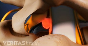 Outpatient Spine Surgery Considerations