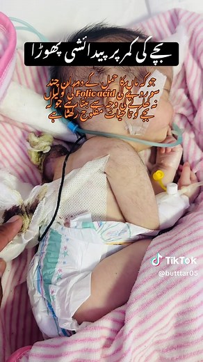 Myelomeningocele: Caused by Folic Acid Deficiency in Pregnancy