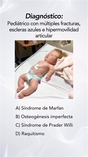 Meissner. Do medicine. on Instagram: "¿Cuál sería tu diagnóstico al encontrar px pediátrico con múltiples fracturas, escleras azules e hipermovilidad articular? . . . . . B) La osteogénesis imperfecta (OI) es un grupo heterogéneo de displasias esqueléticas hereditarias caracterizadas principalmente por fragilidad ósea, baja densidad mineral ósea y susceptibilidad a fracturas con traumas mínimos. Además de la fragilidad ósea, pueden presentarse otros hallazgos como talla baja, macrocefalia, defor