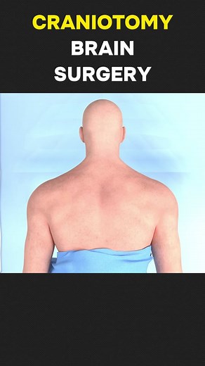 Brain Tumor Removal Surgery 3D Animation (Craniotomy) #craniotomy #craniotomysurvivor #craniotomyrecovery #craniotomysurgeon #braintumor #braintumorawarness #braintumorsurvivor #braintumorsurgery #braintumorsurgerysurvivor