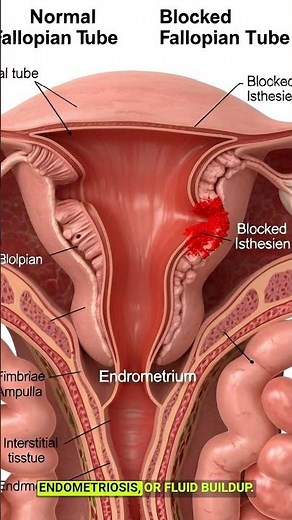 How Fallopian Tubes Get Blocked – Female Infertility Explained in 3D
