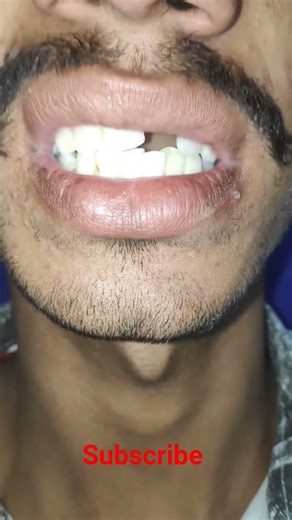 RPD for missing teeth 🦷✨⚡🎉💥💫 #dentist #smiledesigndental #dentalclinic