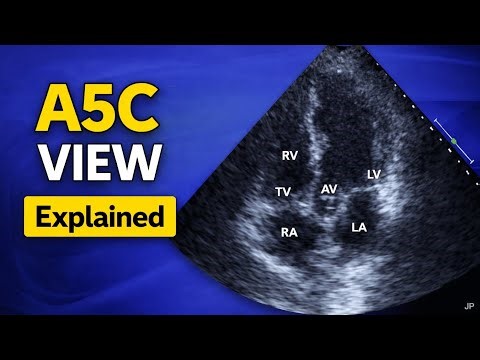 Apical 5 Chamber View Explained | Echocardiography Basics