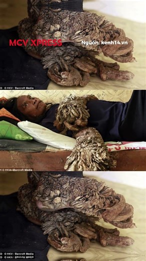 Hành trình 42 năm chống chọi với lời nguyền của người đàn ông Indonesia | MCV Xpress