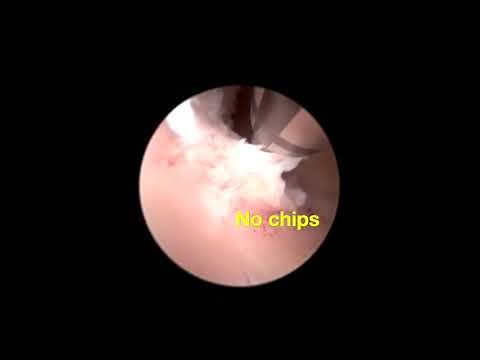 41) Hysteroscopic polypectomy with Truclear Elite in office