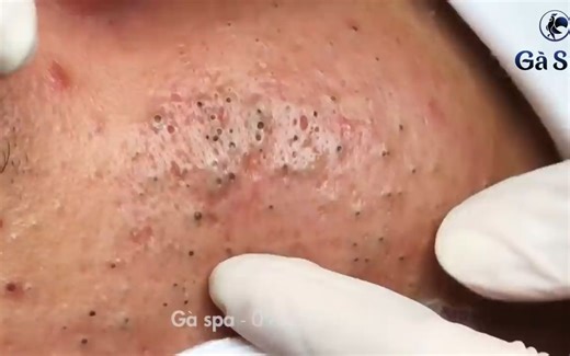 Best Blackhead Removal Ever 55min - Facial Acne Treatment - Gà Spa