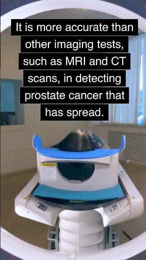 PYLARIFY® - (piflufolastat F 18) Injection PET/CT Imaging in Prostate Cancer Patient