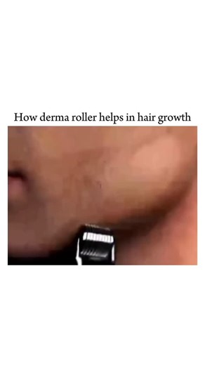 NOCODUSA on Instagram: "Derma rollers help in hair growth by using tiny microneedles to create controlled micro-injuries on the scalp. These tiny punctures activate the body’s natural healing response, triggering several powerful biological processes that support thicker, healthier hair. When the scalp is lightly punctured, it boosts blood circulation, bringing oxygen and nutrients directly to weak hair follicles. It also stimulates collagen production, which strengthens the hair root and improv