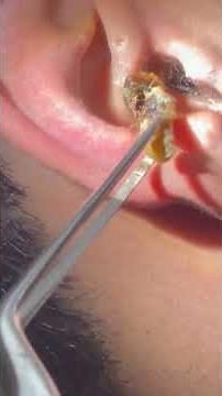 Successful Removal of Massive Obstructive Ear Wax from Both Auditory Canals.